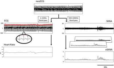 Temporal Clustering of Skin Sympathetic Nerve Activity Bursts in Acute Myocardial Infarction Patients